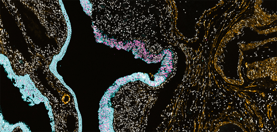 This microscopic view shows the molecular features of an early ovarian precancer (highlighted in aqua and pink). IMAGE: SANTAGATA LAB
