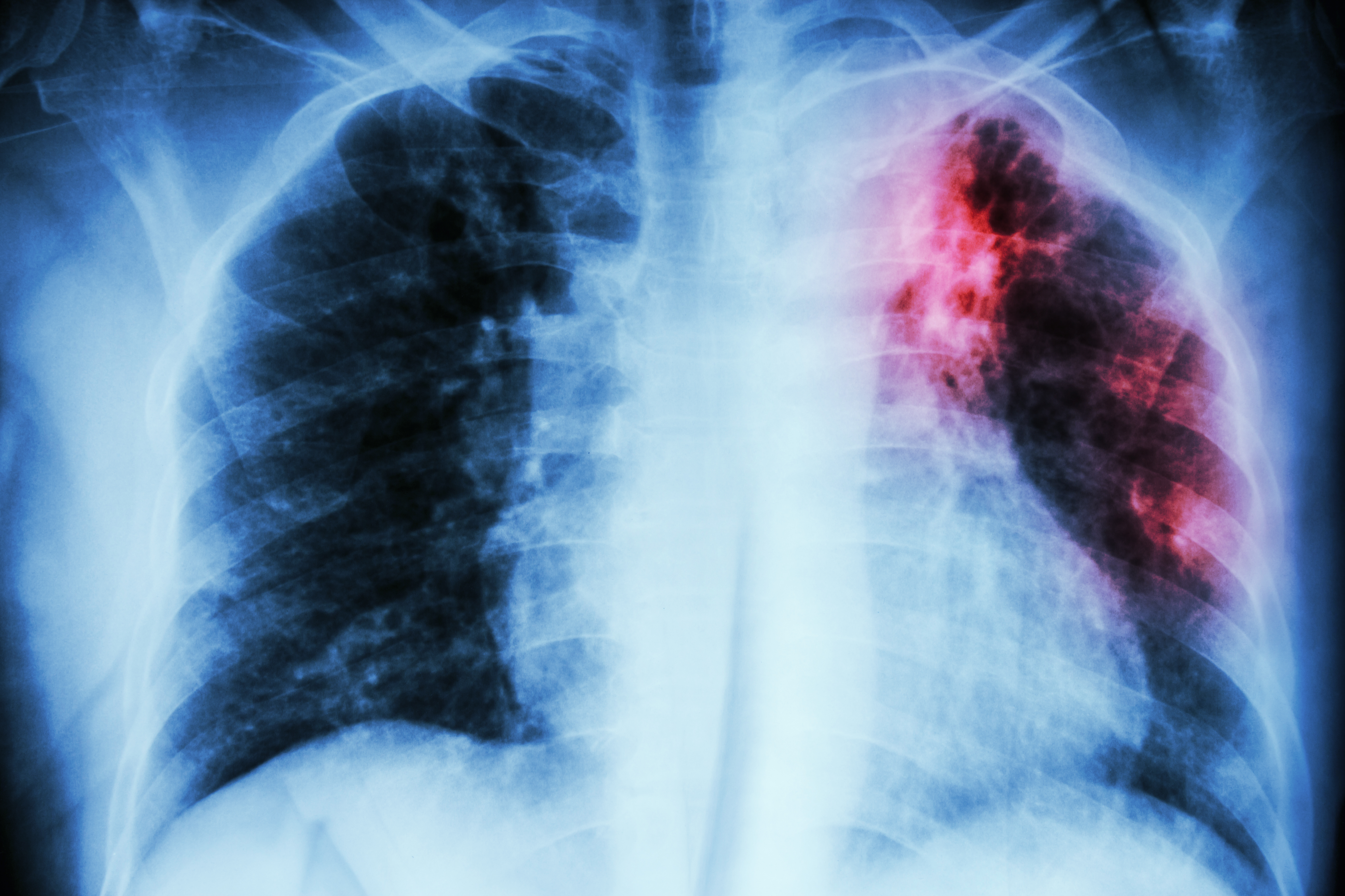 Lung infected by TB