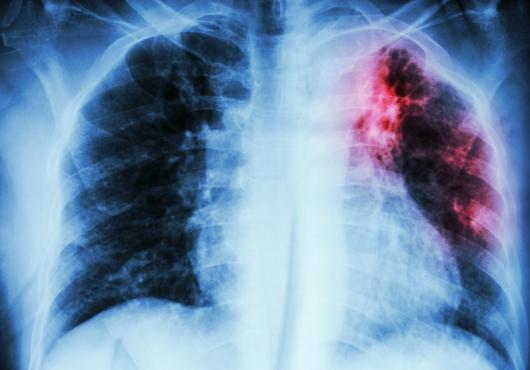 Lung infected by TB
